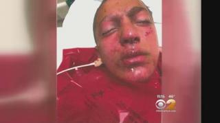 Electronic Cigarette Explodes in Teen's Face, Partially Blinded