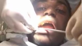 Kodak Black Gets Permanent Gold Teeth Removed